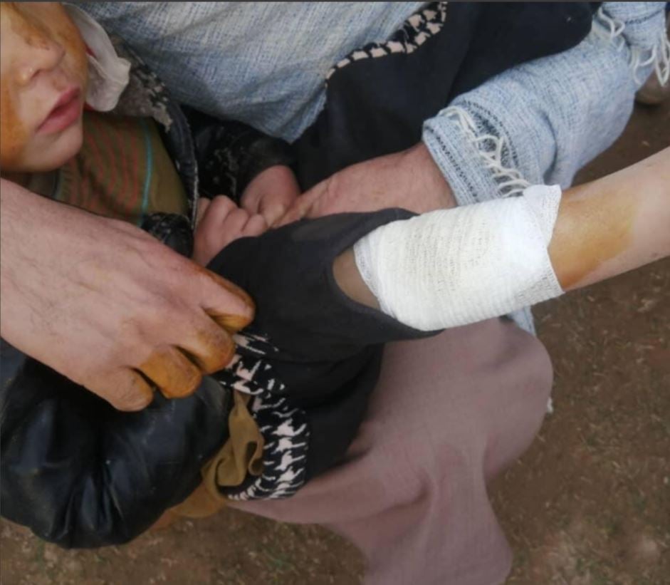 A young boy with an injured leg being held by someone.
